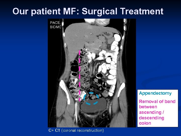 Our patient MF: Surgical Treatment PACS, BIDMC Appendectomy Removal of band between ascending /