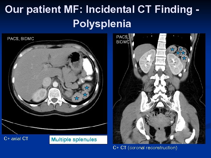 Our patient MF: Incidental CT Finding Polysplenia PACS, BIDMC C+ axial CT Multiple splenules