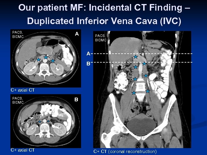 Our patient MF: Incidental CT Finding – Duplicated Inferior Vena Cava (IVC) PACS, BIDMC