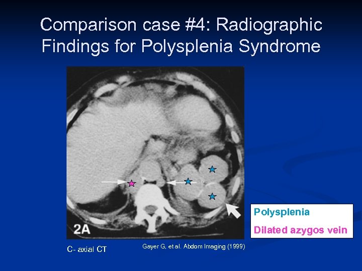 Comparison case #4: Radiographic Findings for Polysplenia Syndrome Polysplenia Dilated azygos vein C- axial