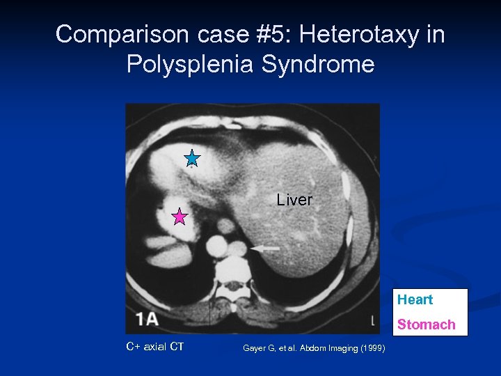 Comparison case #5: Heterotaxy in Polysplenia Syndrome Liver Heart Stomach C+ axial CT Gayer