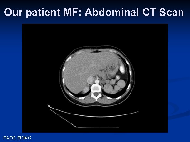 Our patient MF: Abdominal CT Scan PACS, BIDMC 