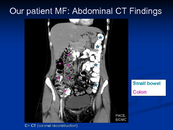 Our patient MF: Abdominal CT Findings Small bowel Colon PACS, BIDMC C+ CT (coronal