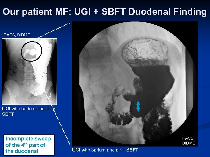 Our patient MF: UGI + SBFT Duodenal Finding PACS, BIDMC UGI with barium and