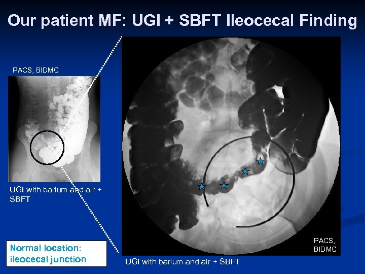 Our patient MF: UGI + SBFT Ileocecal Finding PACS, BIDMC UGI with barium and