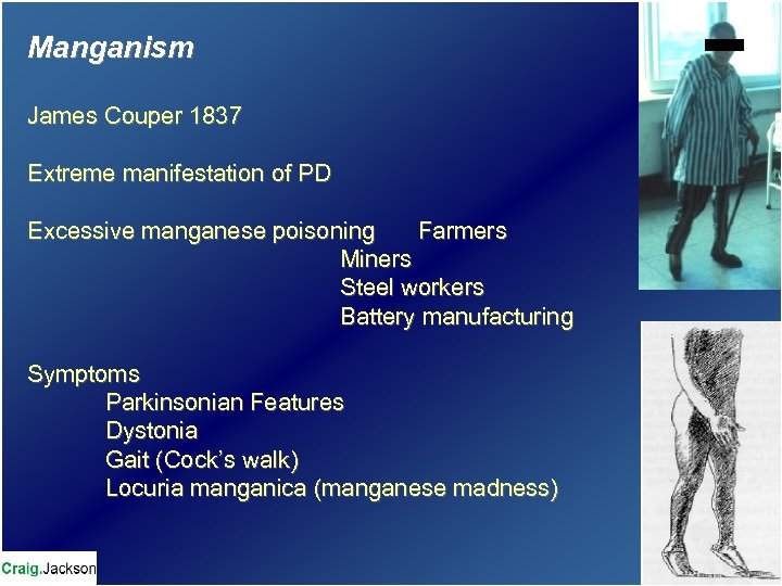 Manganism James Couper 1837 Extreme manifestation of PD Excessive manganese poisoning Farmers Miners Steel