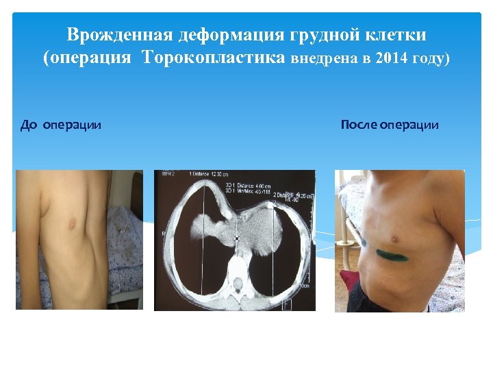 Врожденная деформация грудной клетки (операция Торокопластика внедрена в 2014 году) До операции После операции