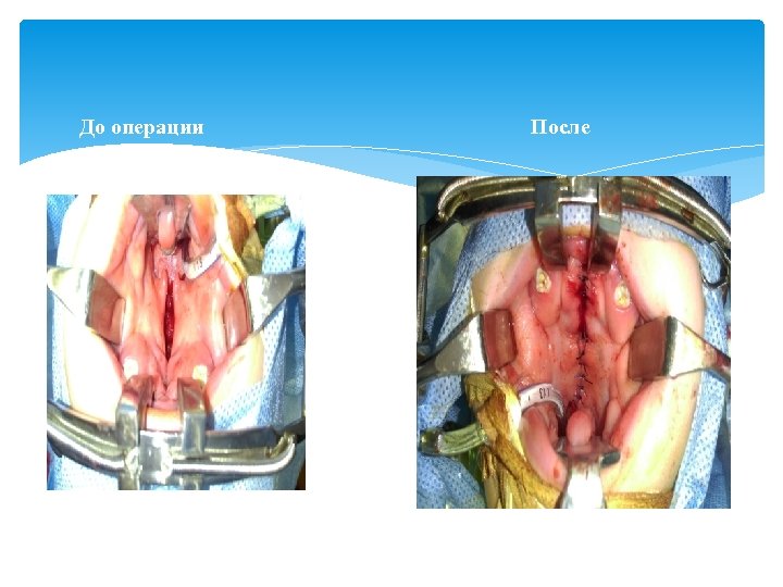 До операции После 