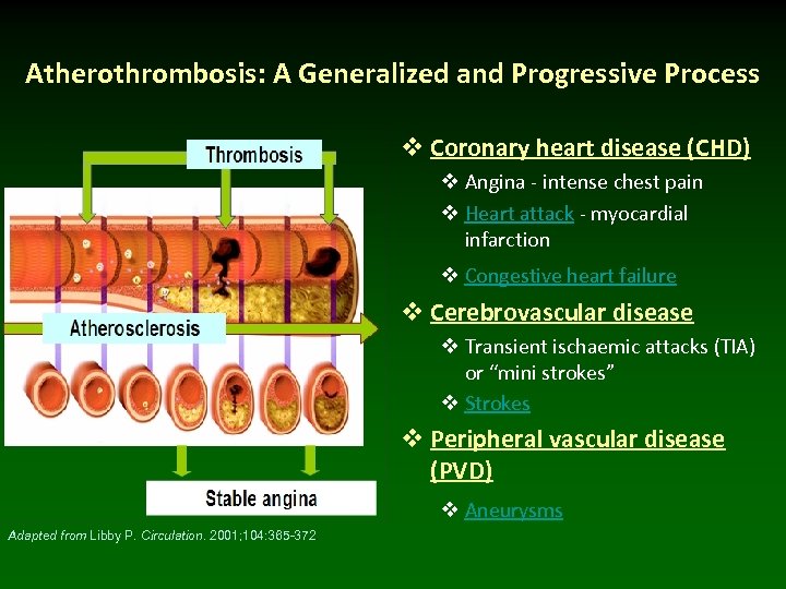 Atherothrombosis: A Generalized and Progressive Process v Coronary heart disease (CHD) v Angina -