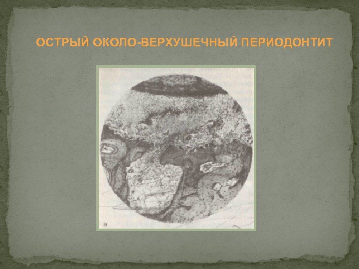 ОСТРЫЙ ОКОЛО ВЕРХУШЕЧНЫЙ ПЕРИОДОНТИТ 