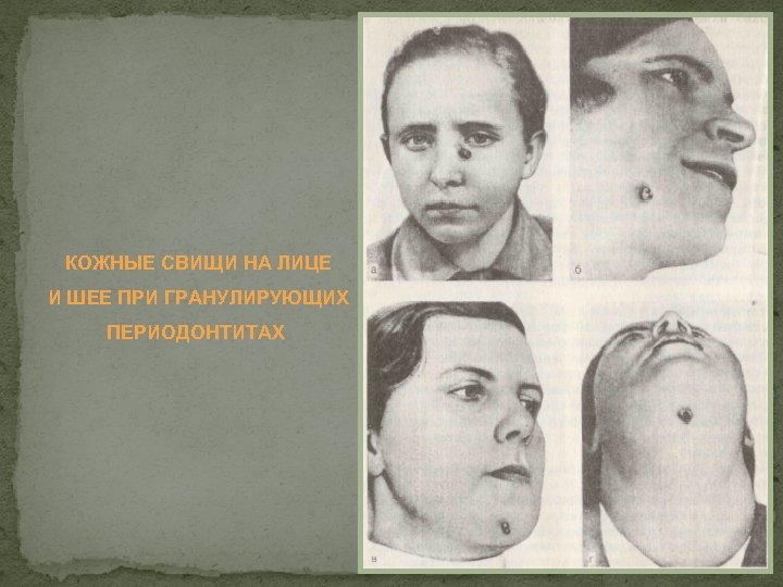 КОЖНЫЕ СВИЩИ НА ЛИЦЕ И ШЕЕ ПРИ ГРАНУЛИРУЮЩИХ ПЕРИОДОНТИТАХ 