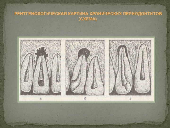 РЕНТГЕНОЛОГИЧЕСКАЯ КАРТИНА ХРОНИЧЕСКИХ ПЕРИОДОНТИТОВ (СХЕМА) 