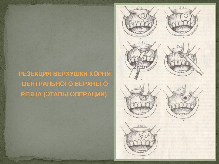 РЕЗЕКЦИЯ ВЕРХУШКИ КОРНЯ ЦЕНТРАЛЬНОГО ВЕРХНЕГО РЕЗЦА (ЭТАПЫ ОПЕРАЦИИ) 