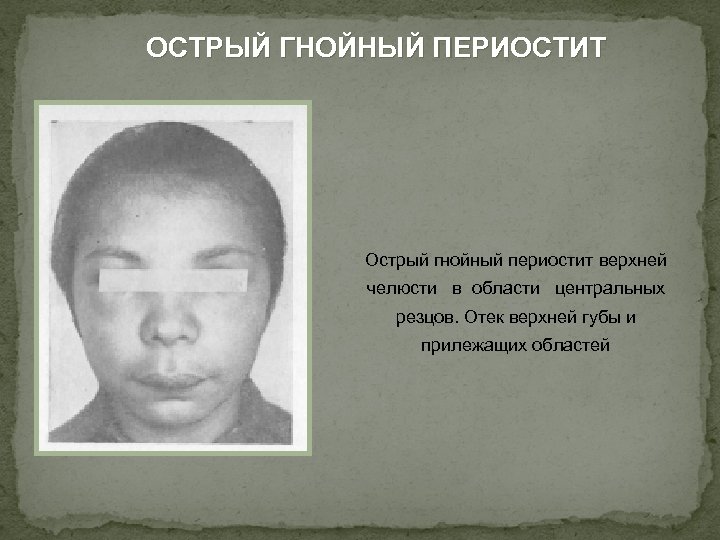 ОСТРЫЙ ГНОЙНЫЙ ПЕРИОСТИТ Острый гнойный периостит верхней челюсти в области центральных резцов. Отек верхней