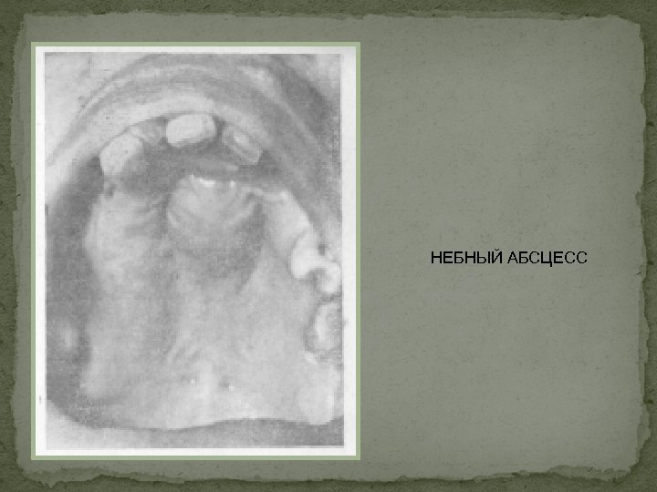 НЕБНЫЙ АБСЦЕСС 