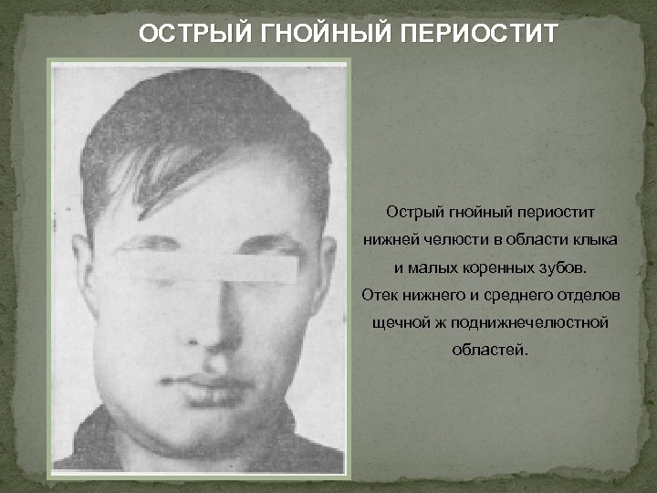 ОСТРЫЙ ГНОЙНЫЙ ПЕРИОСТИТ Острый гнойный периостит нижней челюсти в области клыка и малых коренных