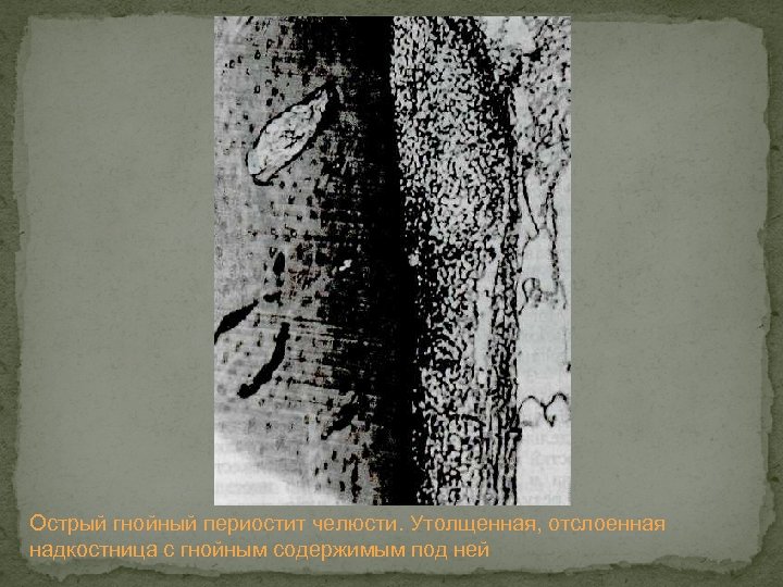 Острый гнойный периостит челюсти. Утолщенная, отслоенная надкостница с гнойным содержимым под ней 