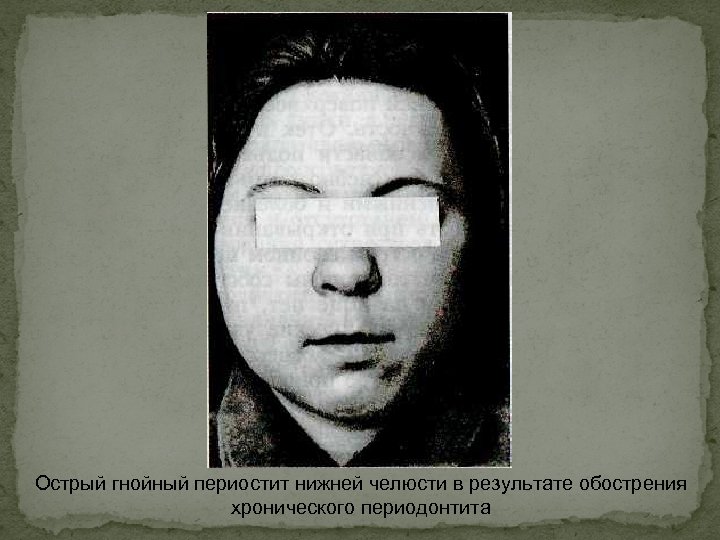 Острый гнойный периостит нижней челюсти в результате обострения хронического периодонтита 