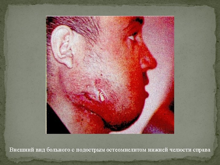 Внешний вид больного с подострым остеомиелитом нижней челюсти справа 