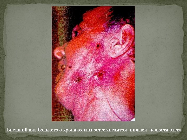 Внешний вид больного с хроническим остеомиелитом нижней челюсти слева 