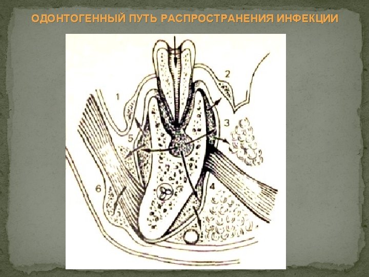 ОДОНТОГЕННЫЙ ПУТЬ РАСПРОСТРАНЕНИЯ ИНФЕКЦИИ 