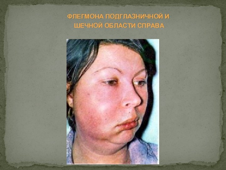 ФЛЕГМОНА ПОДГЛАЗНИЧНОЙ И ШЕЧНОЙ ОБЛАСТИ СПРАВА 