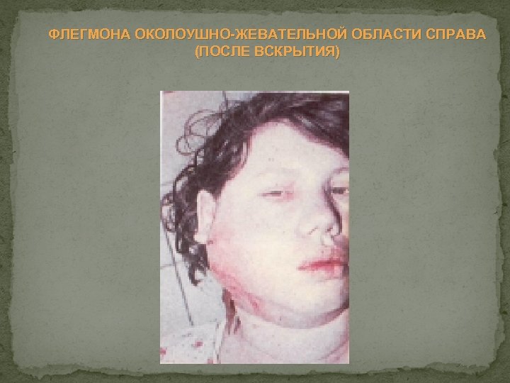 ФЛЕГМОНА ОКОЛОУШНО ЖЕВАТЕЛЬНОЙ ОБЛАСТИ СПРАВА (ПОСЛЕ ВСКРЫТИЯ) 