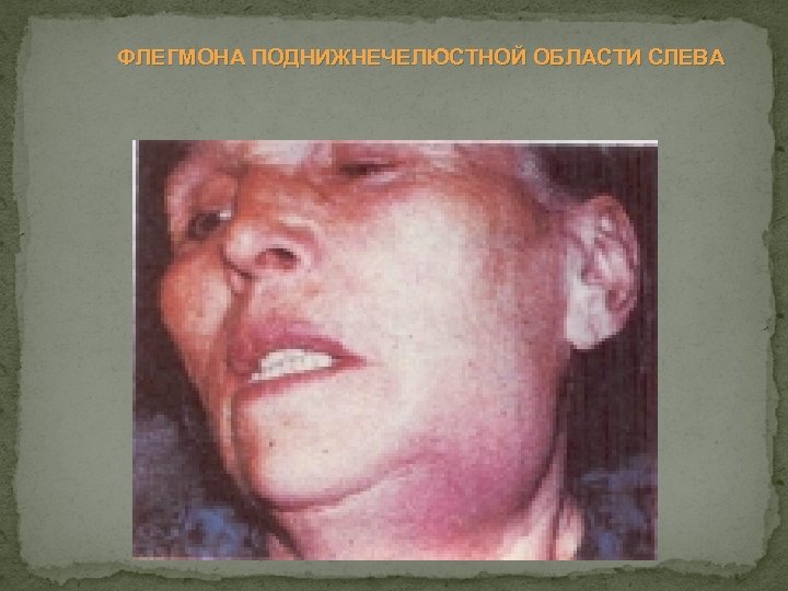 ФЛЕГМОНА ПОДНИЖНЕЧЕЛЮСТНОЙ ОБЛАСТИ СЛЕВА 