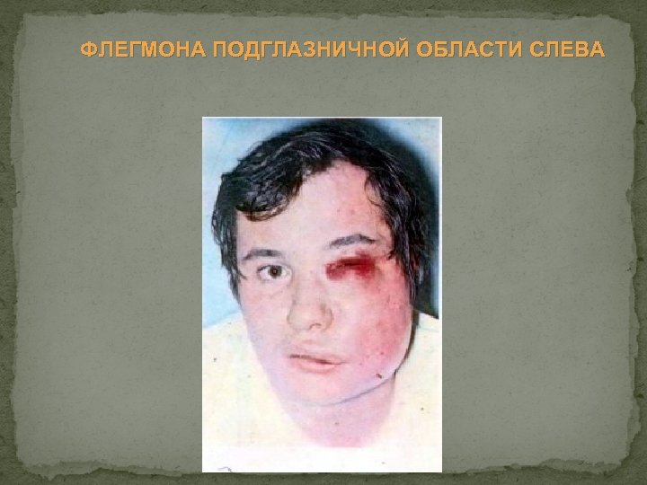 ФЛЕГМОНА ПОДГЛАЗНИЧНОЙ ОБЛАСТИ СЛЕВА 