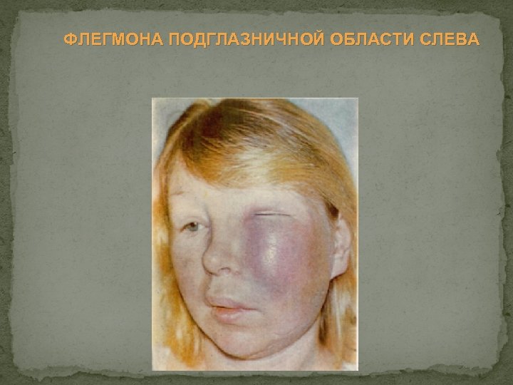 ФЛЕГМОНА ПОДГЛАЗНИЧНОЙ ОБЛАСТИ СЛЕВА 