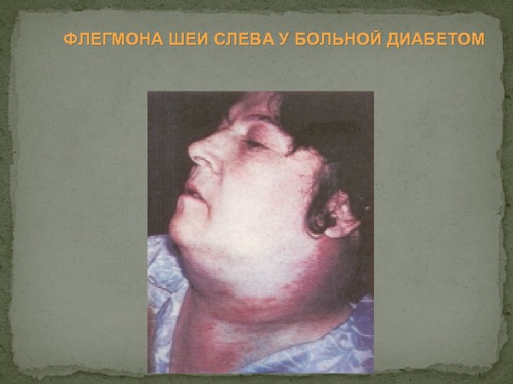 ФЛЕГМОНА ШЕИ СЛЕВА У БОЛЬНОЙ ДИАБЕТОМ 