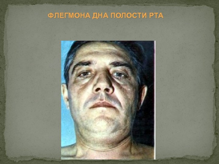 ФЛЕГМОНА ДНА ПОЛОСТИ РТА 