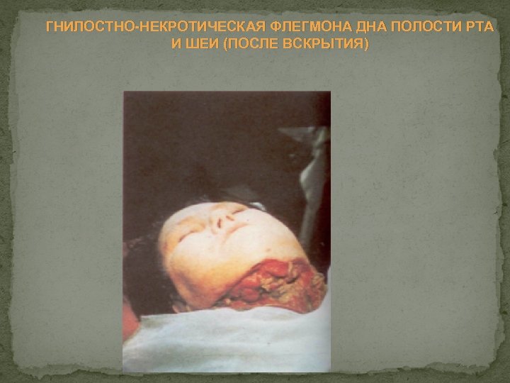 ГНИЛОСТНО НЕКРОТИЧЕСКАЯ ФЛЕГМОНА ДНА ПОЛОСТИ РТА И ШЕИ (ПОСЛЕ ВСКРЫТИЯ) 
