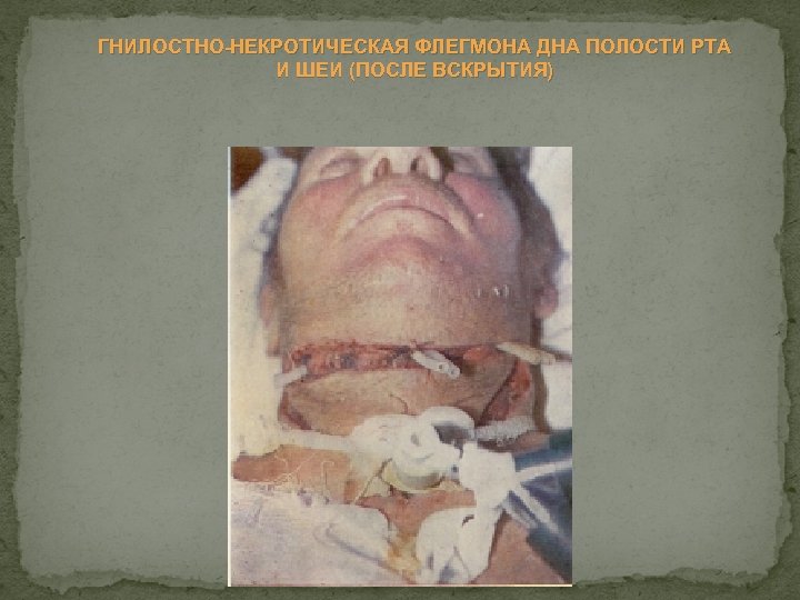 ГНИЛОСТНО НЕКРОТИЧЕСКАЯ ФЛЕГМОНА ДНА ПОЛОСТИ РТА И ШЕИ (ПОСЛЕ ВСКРЫТИЯ) 
