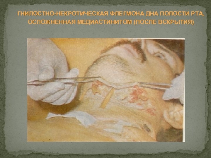 ГНИЛОСТНО НЕКРОТИЧЕСКАЯ ФЛЕГМОНА ДНА ПОЛОСТИ РТА, ОСЛОЖНЕННАЯ МЕДИАСТИНИТОМ (ПОСЛЕ ВСКРЫТИЯ) 