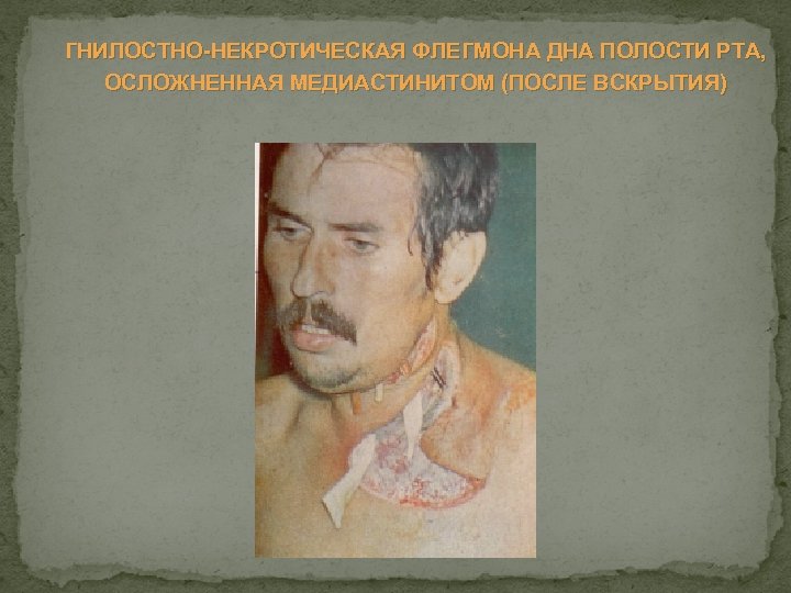 ГНИЛОСТНО НЕКРОТИЧЕСКАЯ ФЛЕГМОНА ДНА ПОЛОСТИ РТА, ОСЛОЖНЕННАЯ МЕДИАСТИНИТОМ (ПОСЛЕ ВСКРЫТИЯ) 