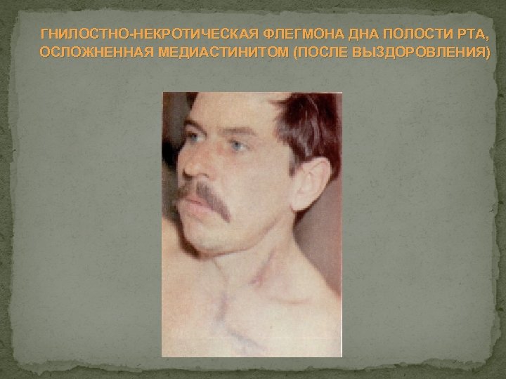 ГНИЛОСТНО НЕКРОТИЧЕСКАЯ ФЛЕГМОНА ДНА ПОЛОСТИ РТА, ОСЛОЖНЕННАЯ МЕДИАСТИНИТОМ (ПОСЛЕ ВЫЗДОРОВЛЕНИЯ) 