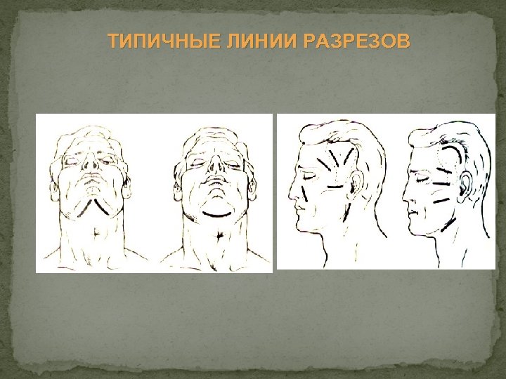 ТИПИЧНЫЕ ЛИНИИ РАЗРЕЗОВ 