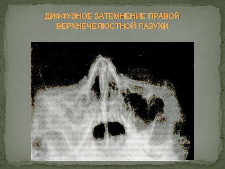 ДИФФУЗНОЕ ЗАТЕМНЕНИЕ ПРАВОЙ ВЕРХНЕЧЕЛЮСТНОЙ ПАЗУХИ 