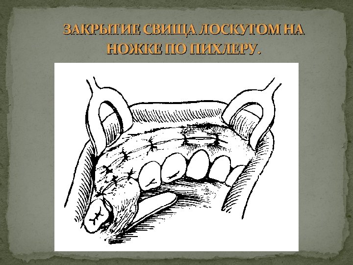 ЗАКРЫТИЕ СВИЩА ЛОСКУТОМ НА НОЖКЕ ПО ПИХЛЕРУ. 