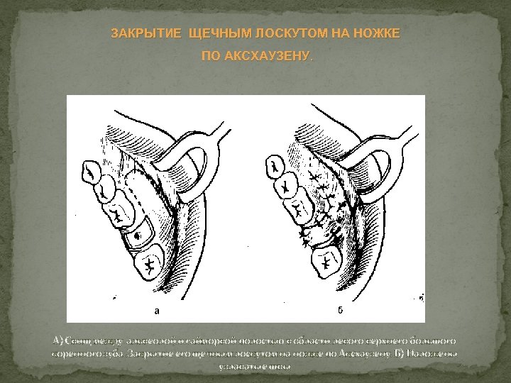 ЗАКРЫТИЕ ЩЕЧНЫМ ЛОСКУТОМ НА НОЖКЕ ПО АКСХАУЗЕНУ. А) Свищ между альвеолой и гайморвой полостью
