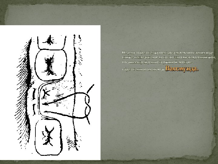 На рану, образовавшуюся в результате иссечения хода свища, накладывают, по возможности, матрасный шов, соединяя