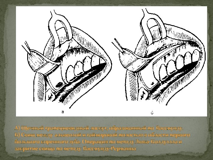 А) Щечный трапециевидный лоскут, образованный по Вассмунду. Б) Свищ между альвеолой и гайморовой полостью