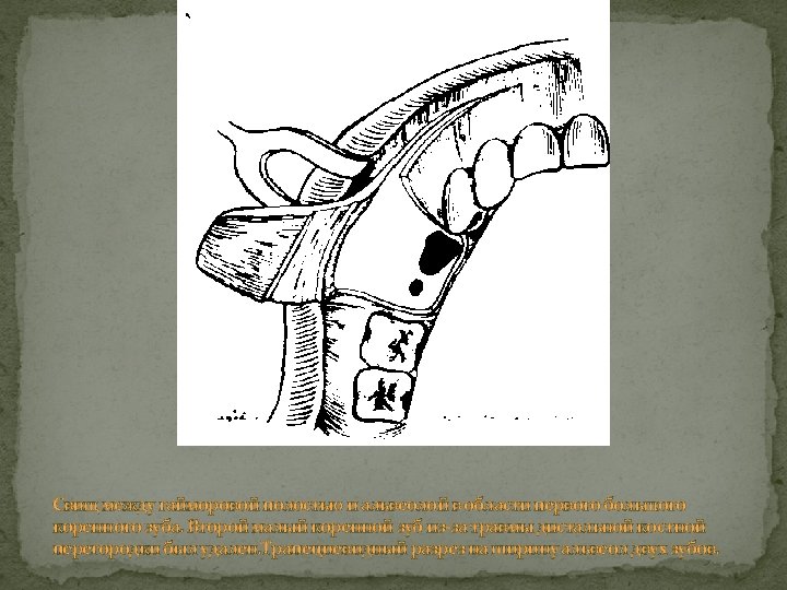 Свищ между гайморовой полостью и альвеолой в области первого большого коренного зуба. Второй малый