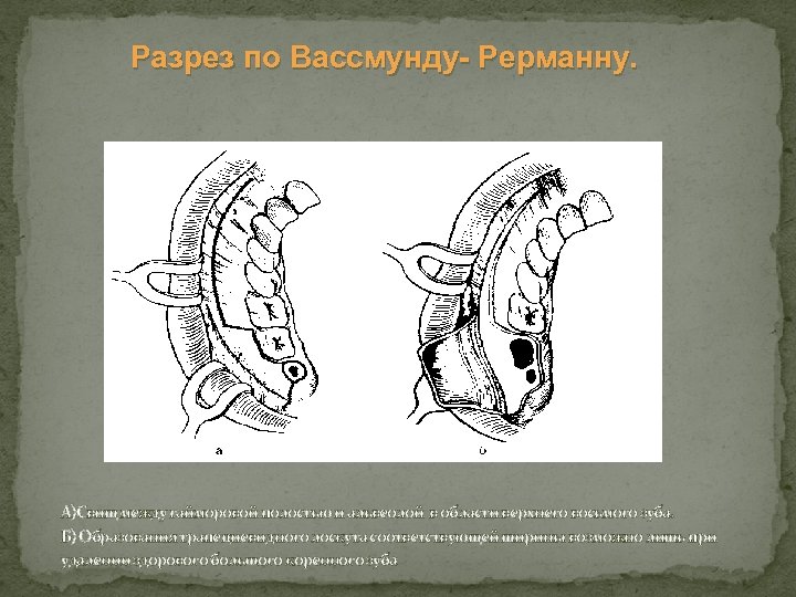 Разрез по Вассмунду Рерманну. А)Свищ между гайморовой полостью и альвеолой в области верхнего восьмого