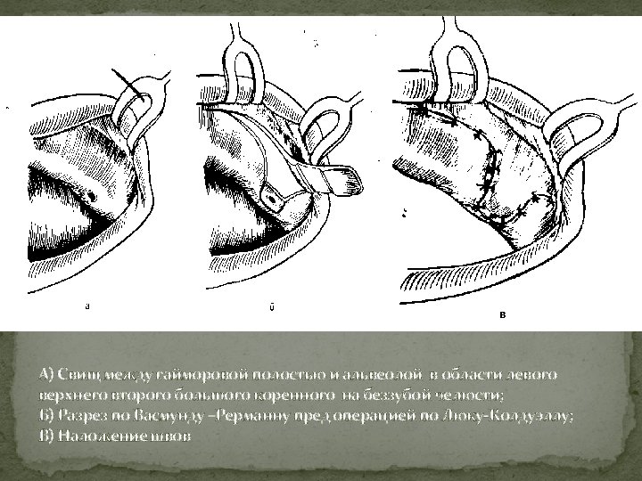 А) Свищ между гайморовой полостью и альвеолой в области левого верхнего второго большого коренного