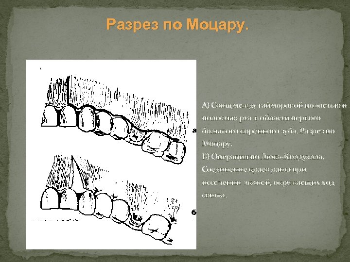 Разрез по Моцару. А) Свищ между гайморовой полостью и полостью рта в области первого