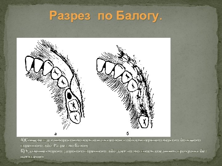 Разрез по Балогу. А)Свищ между гайморовой полостью и альвеолой в области верхнего первого большого
