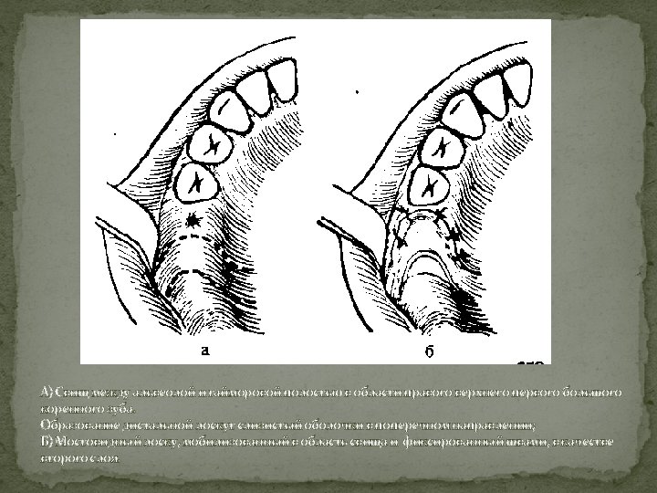 А) Свищ между альвеолой и гайморовой полостью в области правого верхнего первого большого коренного