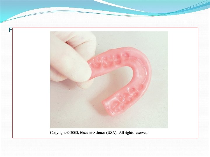 Fig. 46 -27 Wax bite registration. 